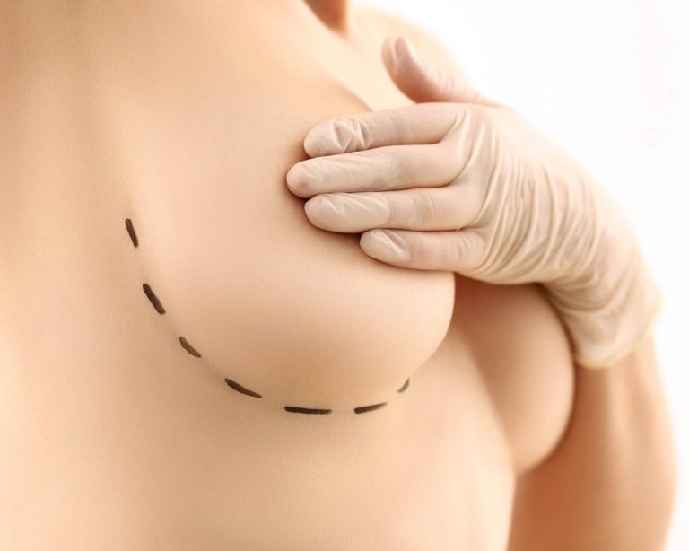 mamoplastia