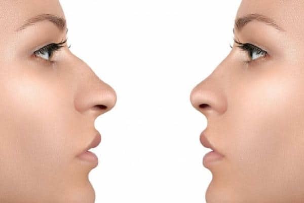 Rinoplastia
