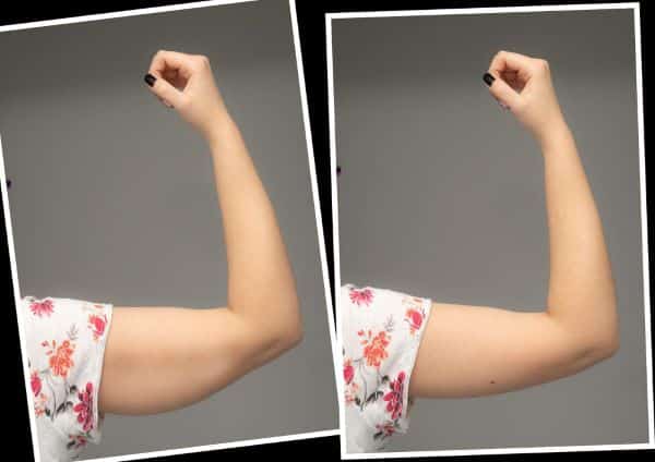 Lifting de braços - antes e depois