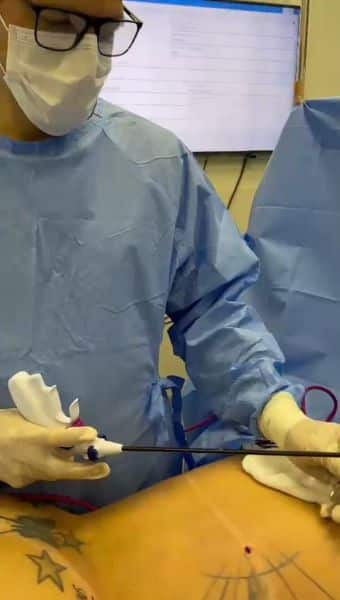 Dr. Carlos Kuyven utilizando o Renuvion para tratamento da flacidez de pele.