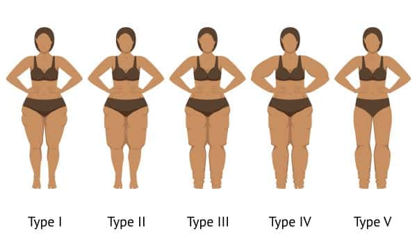 Gravura de corpo feminino demonstrando os diferentes tipos de lipedema.