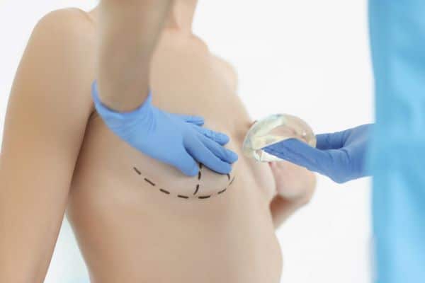 Mastopexia com próteses de siliconne. Dr. marca o seio de paciente e mostra o tipo de próteses de silicone que irá utilizar.