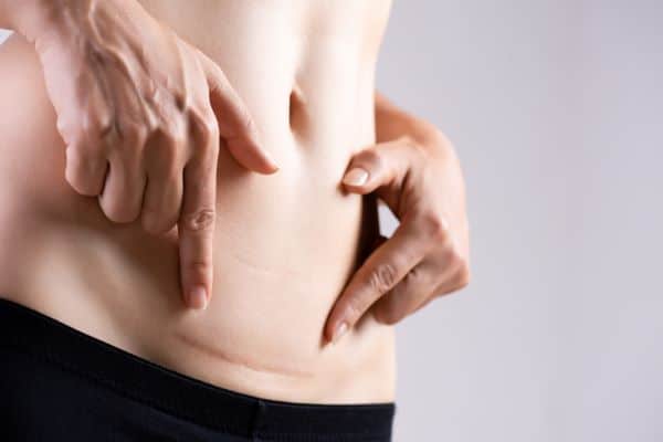 Mulher usando uma lingerie preta aponta para uma cicatriz no ventre, fruto de uma cirurgia.
