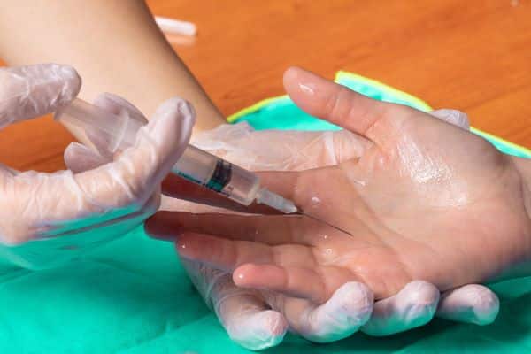 Médico aplicando toxina botulínica na palma da mão de jovem que apresenta hiperidrose.