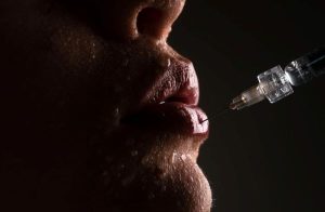 Ajuste dos lábios feito com seringa em boca feminina usando injeção de ácido hialurônico.
