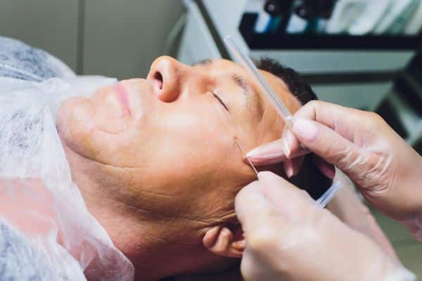 Close-up do procedimento com fios de sustentação para lifting facial.