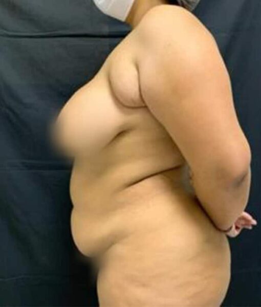 Abdominoplastia circunferencial em paciente com grande perda de peso.
ANTES
