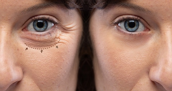 Antes e depois de blefaroplastia transconjuntival. 
Na imagem, close do rosto de uma mulher com olhos azuis. Na primeira imagem a marcação na pálpebra inferior onde será feito o procedimento. Na segunda, o resultado da intervenção.