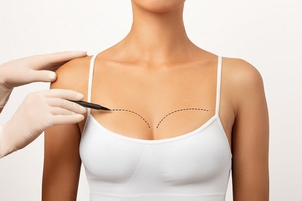 Médico, usando luvas cirúrgicas, marca o colo de paciente para realizar mamoplastia híbrida.