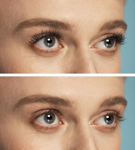 Close no rosto de uma mulher mostrando o ANTES e DEPOIS  de blefaroplastia.
